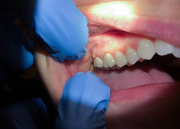Best Emergency Gum Treatment in Mccormick, SC